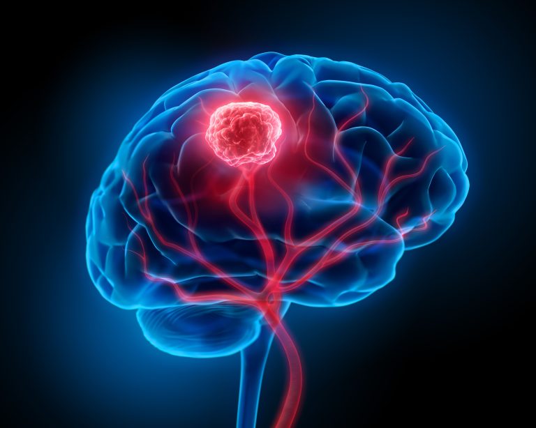 BrainChild Bio完成1.16亿美元A轮融资：CAR T细胞疗法能否改写儿童脑瘤生存期？